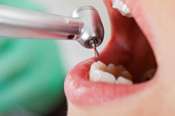 Best Emergency Wisdom Tooth Extraction in Soldotna, AK